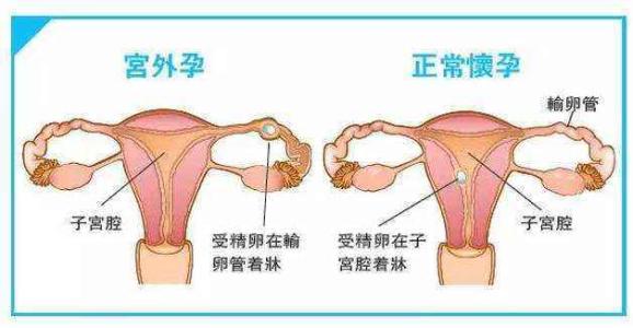 宫外孕的原因是什么？