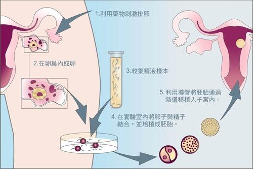 听取专家的意见进行多少次胚胎移植